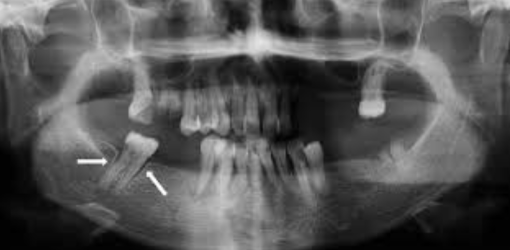 Radio montrant l'élargissement desmodontal apical