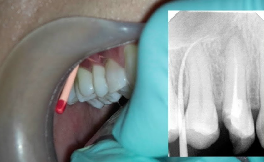 dental fistula sinus tract gutta percha cone radiograph