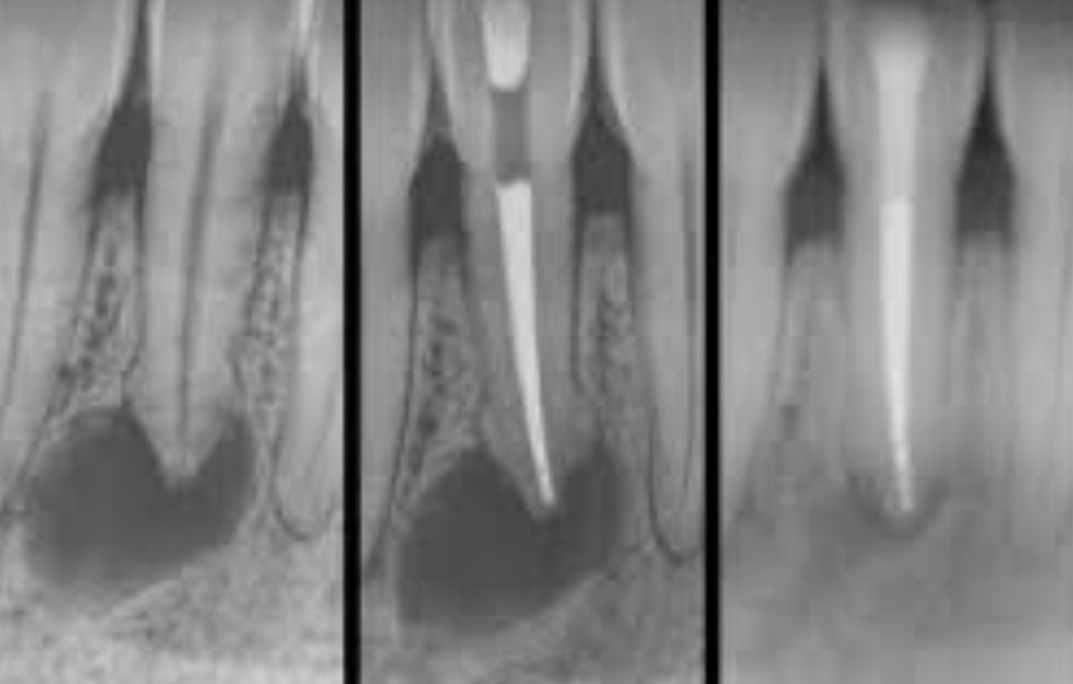 🔍 periapical healing bone regeneration xray before after → Comparatif radio avant/après traitement endodontique (guérison osseuse)