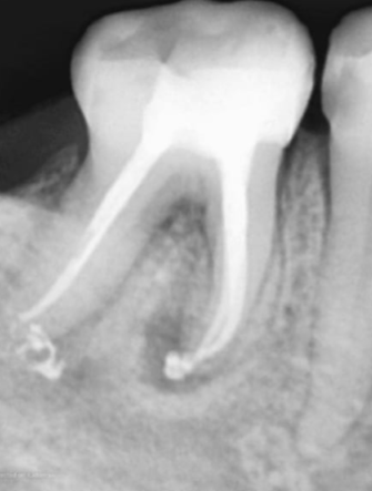 dental periapical x-ray molar restoration