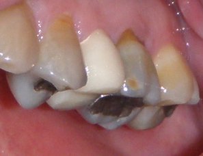 Couronne provisoire en résine ou métallique en place en bouche