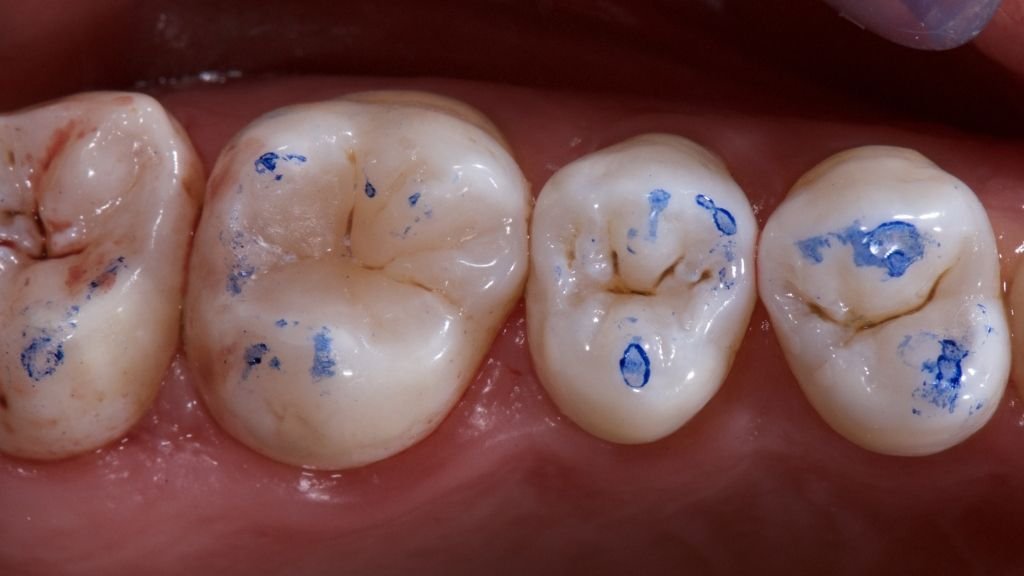 articulating paper dental occlusion check